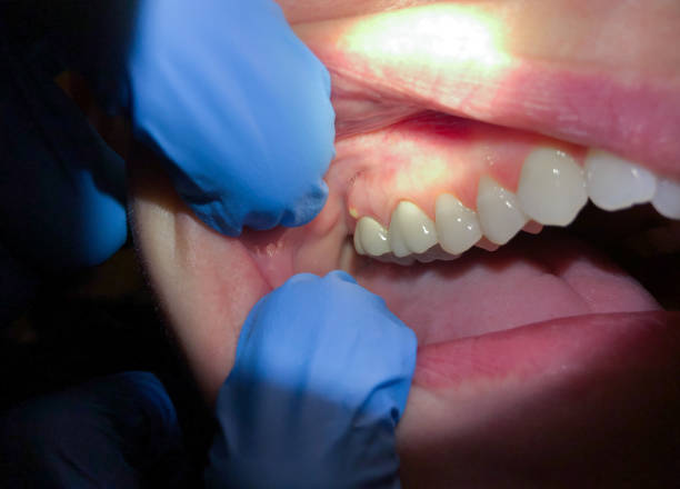 Best Emergency Treatment for Dental Infections or Abscesses in One Loudoun, VA